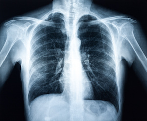 chest xray